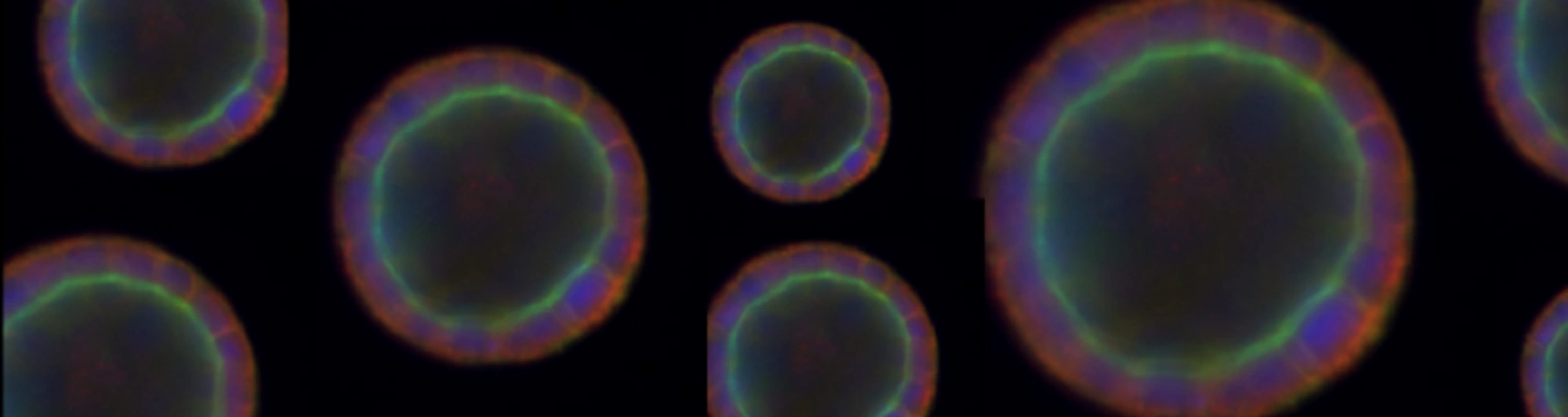 Epithelial cyst formation in 